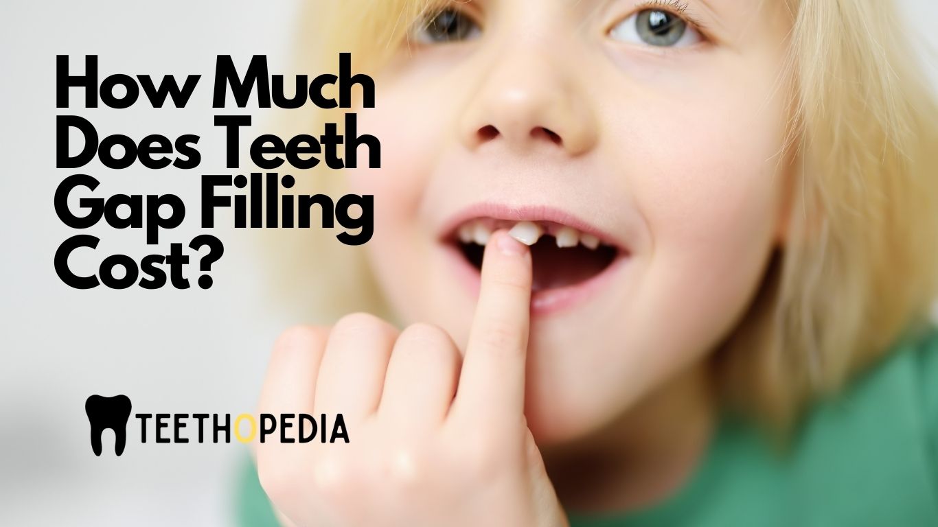 Teeth Gap Filling Cost