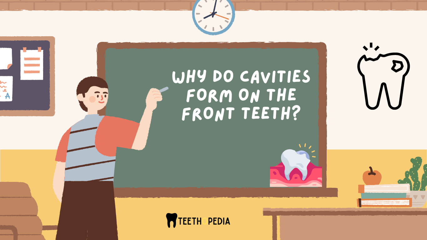 Why do cavities form on the front teeth?